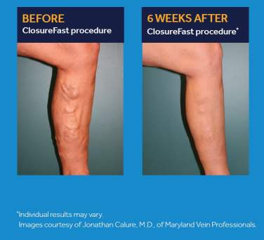 Before image of a leg with veins showing,  and an after image of a the same leg, six weeks after the Closurefast proceedure is used to repair the damaged vein.
