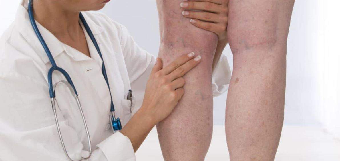 Evaluate legs with doctor