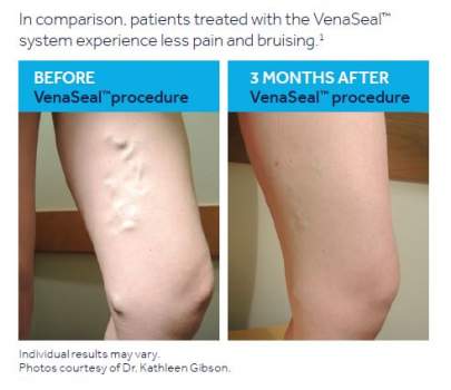 Before image of a leg with veins showing,  and an after image of a the same leg, three months after the VenaSeal™ Closure System  is used to repair the damaged vein.